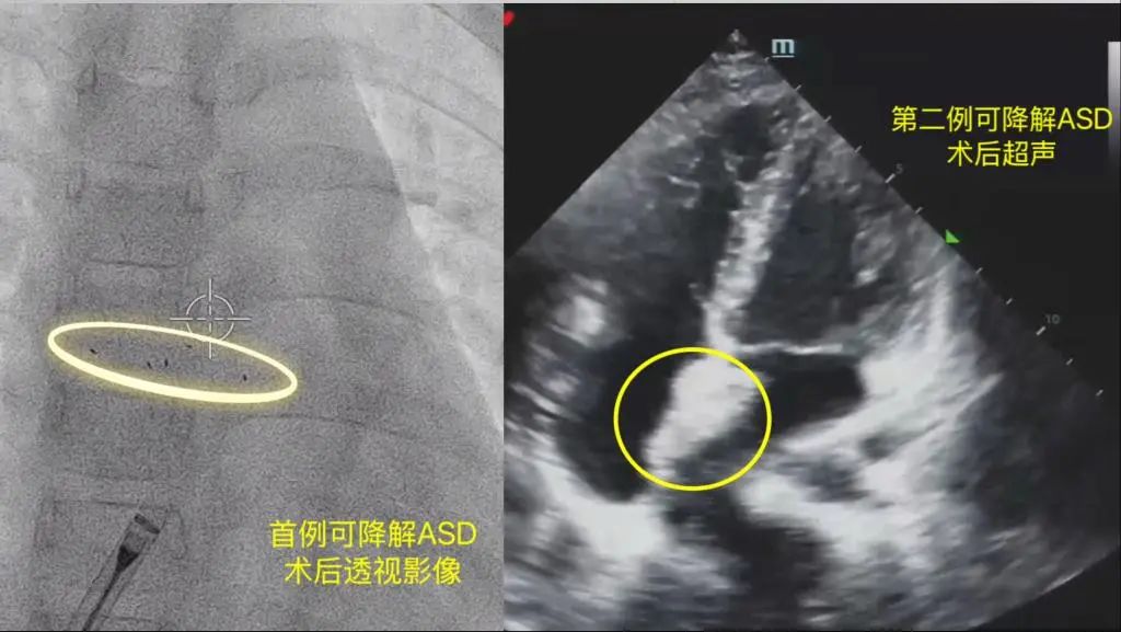 两位先心病少女重获“心”生——山东大学齐鲁医院省内率先成功开展可降解心脏房间隔缺损封堵器植入术
