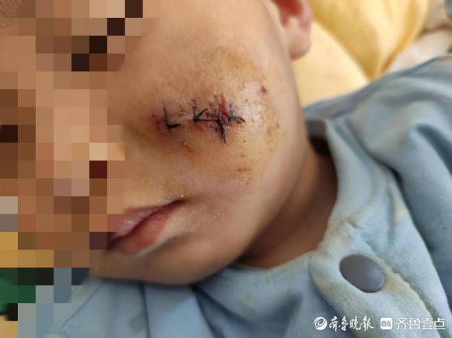 泰安爱民幼业嘉德园老师照顾不当导致男童受伤，赔偿费远不及医药费