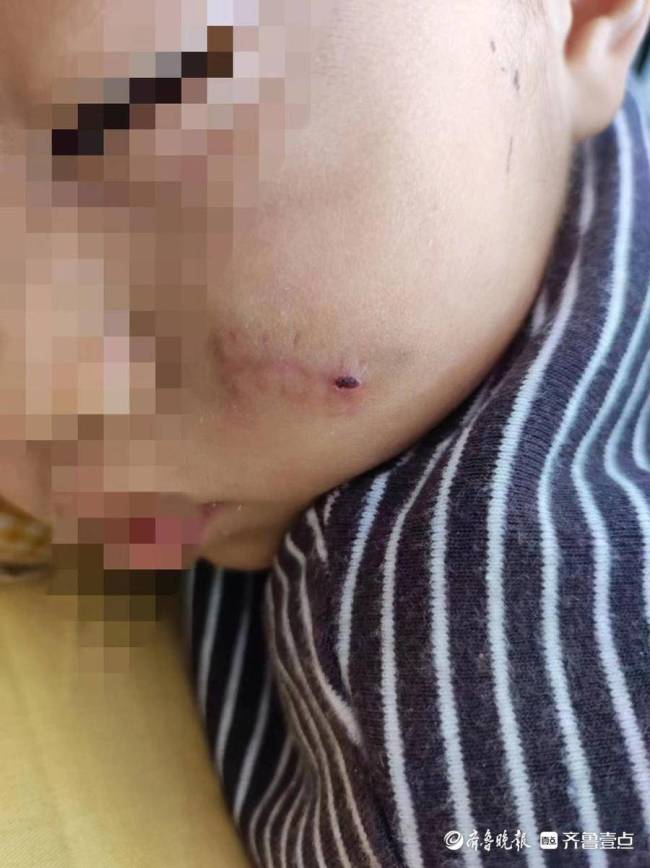 泰安爱民幼业嘉德园老师照顾不当导致男童受伤，赔偿费远不及医药费